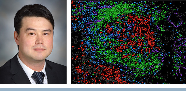 Le Dr Ian Watson, chercheur principal d’une étude publiée dans Science Immunology : grâce à la technique d’imagerie par cytométrie de masse pour observer des lames de tissus prélevés sur des mélanomes, le groupe de recherche a généré des cartes graphiques décrivant l’organisation spatiale du micro-environnement tumoral. Ils ont constaté que la proximité des cellules cytotoxiques T (points oranges) avec les cellules de mélanome (points rouges) est associée avec une meilleure réponse à l’immunothérapie.