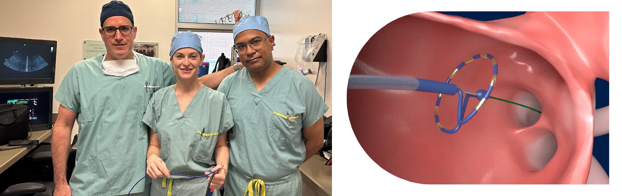 Dr. Vidal Essebag, Dr. Jacqueline Joza and Dr. Atul Verma (L), The Medtronic PulseSelectTM Pulsed Field Ablation (PFA) System (R)