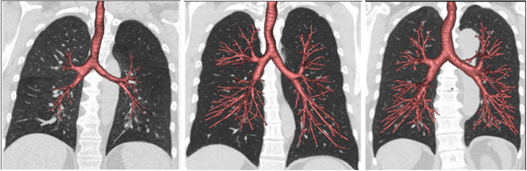 These CT scans of airways (red) and lungs (dark grey) show the spectrum of dysanapsis, with smaller airways in proportion to lung size (left) compared with normal size airways (middle), and larger than normal airways (right).