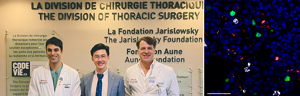 Jonathan Cools-Lartigue, MD, PhD (left) and Lorenzo Ferri, MD, PhD (right) are both clinicians and scientists in the Cancer Research Program of the RI-MUHC. Xin (Daniel) Su, MD, PhD (centre), is a postdoctoral fellow working with Dr. Cools-Lartigue. The image on the right is a fluorescence image of a cancer positive lymph node, showing neutrophils (white) and NETs (red) surrounding and capturing cancer cells (green).