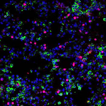 En l’absence de la signalisation de  LTB4, une partie des macrophages inflammatoires (en vert) prolifèrent dans les poumons (marqueur de prolifération en rouge), contribuant ainsi à l’inflammation pulmonaire. Les noyaux des cellules sont en bleu. Les infections par le virus de la grippe se caractérisent par un recrutement massif de macrophages dans les poumons. Bien que ces cellules participent à l’élimination du virus, une inflammation excessive contribue à la sévérité de la maladie. (Microscopie confocale réalisée par Erwan Pernet, IR-CUSM)
