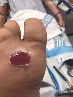 Moulage 1: Open blister on foot