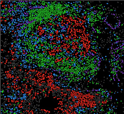 Ayant recours à la technologie de l’imagerie par cytométrie de masse pour observer des lames de tissus prélevés sur des mélanomes, le groupe de chercheurs a construit des graphes décrivant l’organisation spatiale du micro-environnement tumoral. Ils ont constaté que la proximité des cellules cytotoxiques T (points oranges) avec les cellules du mélanome (points rouges) est associée avec une meilleure réponse à l’immunothérapie.
