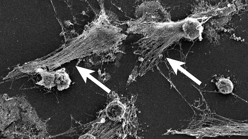 Figure 1. Neutrophiles formant des pièges extracellulaires de neutrophiles (NETs ou neutrophil extracellular traps) en culture cellulaire. Notez les chaînes d'ADN expulsées (flèches). Image obtenue par microscopie électronique à balayage.