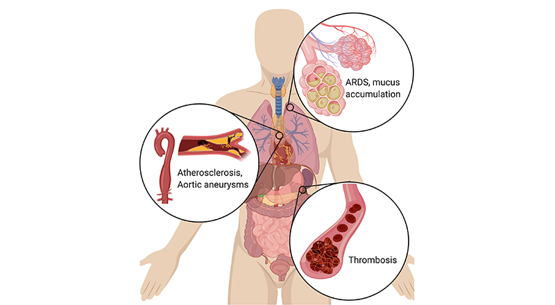 Figure 2. La formation excessive de NETs peut entraîner une variété de pathologies graves. Dans les poumons, les NETs entraînent l'accumulation de mucus dans les voies respiratoires des patients atteints de fibrose kystique. Les NETs sont également à l'origine du syndrome de détresse respiratoire aiguë (SDRA) après l'apparition de divers inducteurs, dont la grippe. Dans le système vasculaire, les NETs provoquent de l'athérosclérose et des anévrismes aortiques, ainsi que de la thrombose (en particulier de la microthrombose), avec des effets dévastateurs sur le fonctionnement des organes.