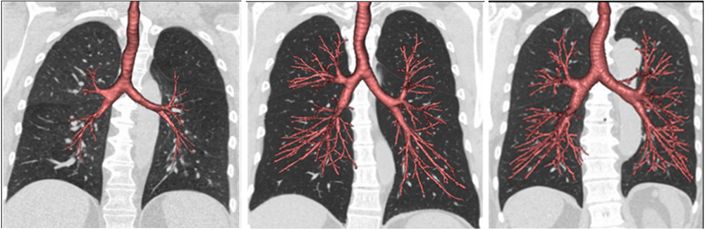 Figure 1. Les tomodensitogrammes ci-dessus, présentant les voies aériennes (en rouge) et les poumons (en gris foncé), démontrent le spectre de la dysanapsie. Les voies respiratoires sont plus petites par rapport à la taille des poumons (à gauche), comparativement à des voies respiratoires de taille normale (photo du milieu) et à des voies respiratoires plus grosses que la normale (photo de droite).